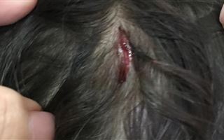 Разбита голова: нянечка толкнула девочку в детском саду в Уральске