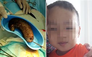 Полтора килограмма волос извлекли хирурги из желудка 4-летнего малыша в Кызылординской области
