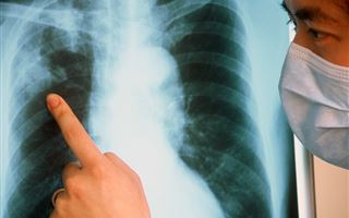 У 12 детей выявили туберкулез в Мангистауской области