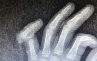 В Алматы ребёнку успешно пришили полностью оторванный палец