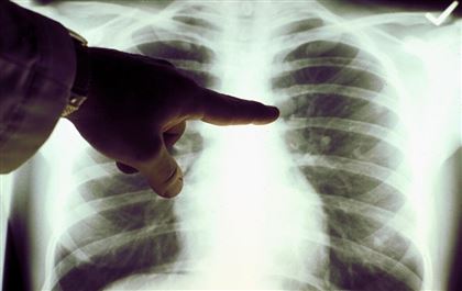 Девять врачей умерли от пневмонии в Шымкенте