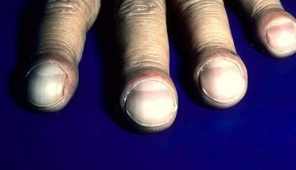 Онкологи заявили, что изменение формы ногтей может быть признаком рака лёгких