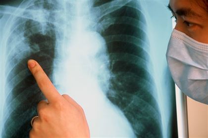 У 12 детей выявили туберкулез в Мангистауской области