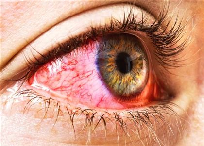 Можно ли ослепнуть от конъюнктивита - рассказал врач-офтальмолог