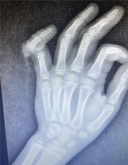 В Алматы ребёнку успешно пришили полностью оторванный палец