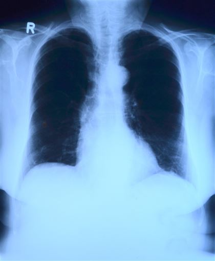 ИИ научился читать рентгеновские снимки не хуже высококвалифицированных врачей
