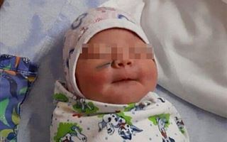 Новорожденному ребенку порезали лицо при кесаревом сечении