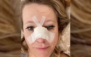 Ксения Собчак сломала нос и получила сотрясение мозга