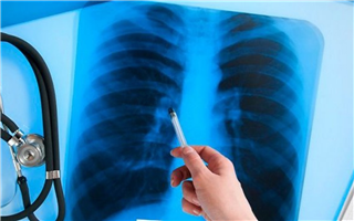 Семь заразных пациентов с туберкулёзом разыскиваются на Севере Казахстана