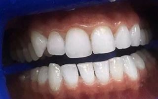 Плохие зубы могут стать причиной инсульта – стоматолог