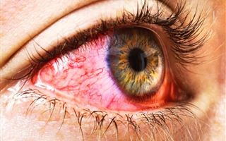 Можно ли ослепнуть от конъюнктивита - рассказал врач-офтальмолог