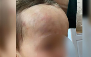 В Павлодаре ребенок из детского сада вернулся с гематомами