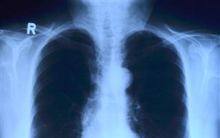 Смертность от туберкулёза снизилась на 83% за последние 5 лет в Алматы