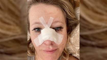 Ксения Собчак сломала нос и получила сотрясение мозга