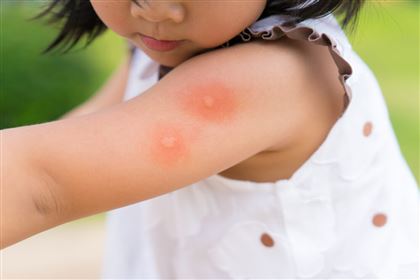 В столице участили случаи аллергии на насекомых среди детей