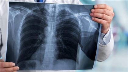 Больных туберкулезом «недовыявили» в Казахстане из-за Covid-19