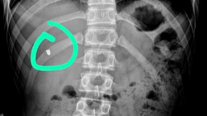 В Мангистау врачи вытащили пулю из грудной клетки подростка