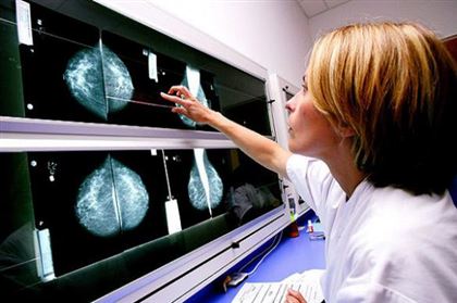 Маммолог рассказал о мифах вокруг рака молочных желез у женщин