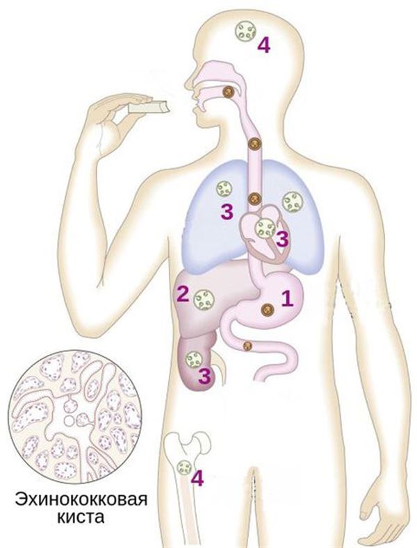 схема инфицирования человека эхинококкозом