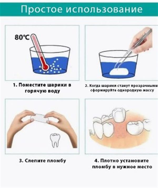 Инструкция по установке пломбы. Если всё так просто, то почему стоматологи столько  лет учатся?